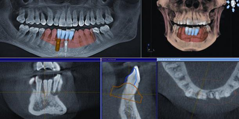 Preservação da crista óssea alveolar após extração dentária na PERFECT SMILE